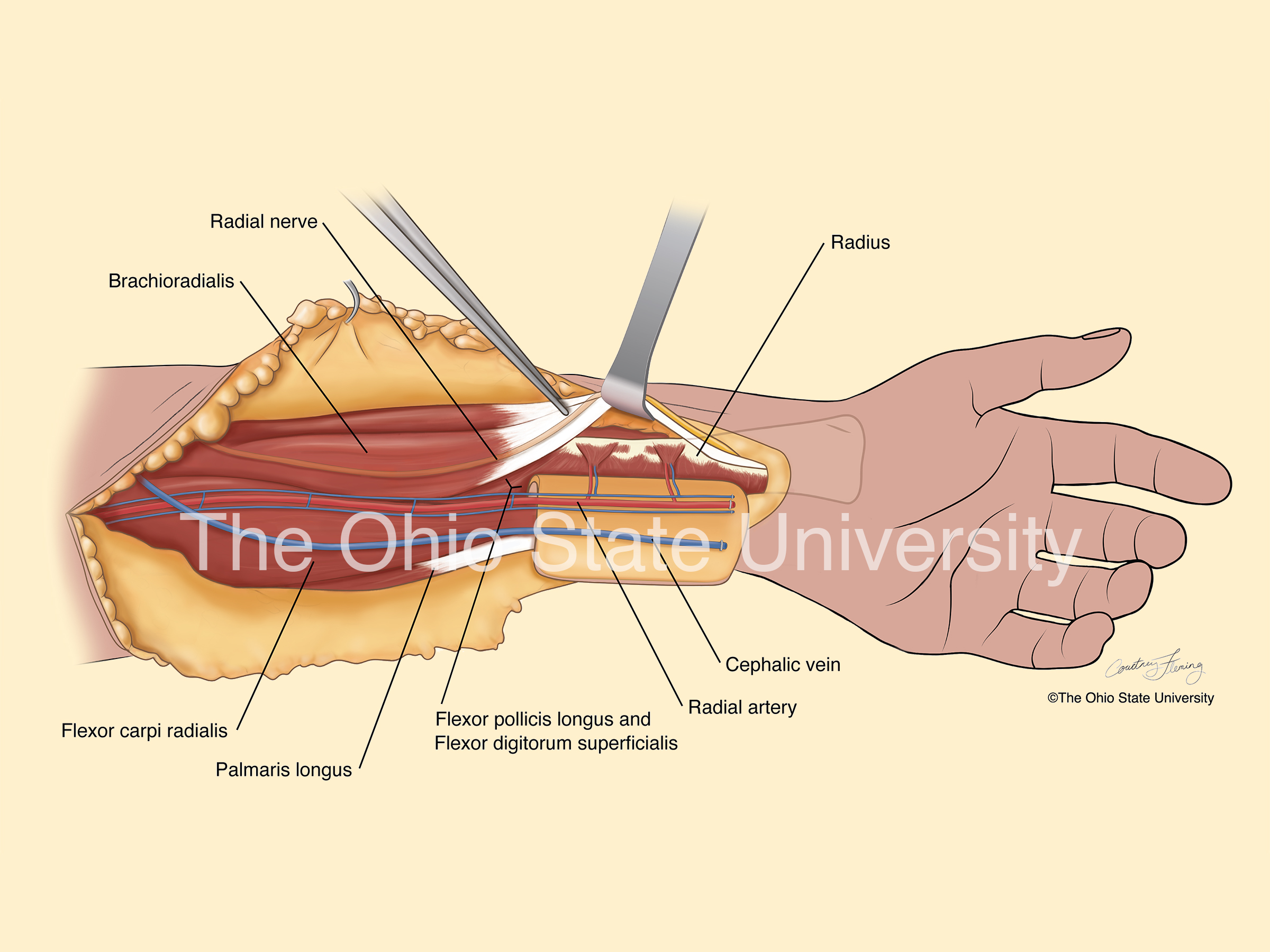 Surgical illustration demonstrating osteocutaneous radial forearm free flap (moderate color)