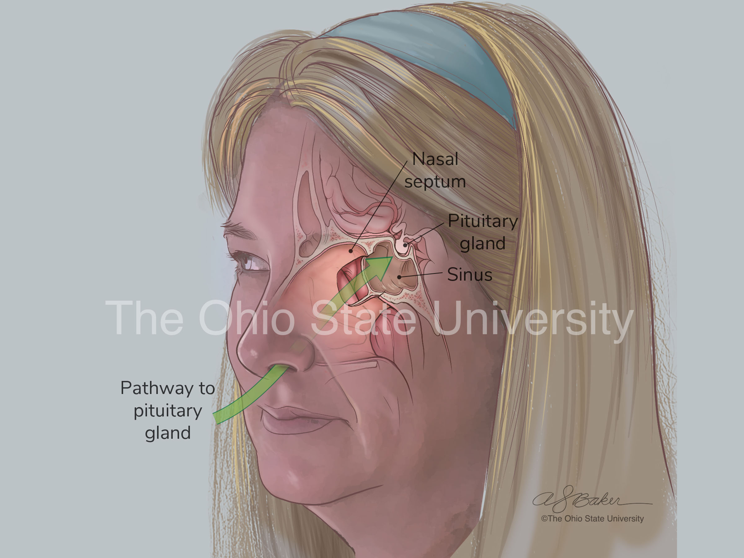 •	Surgical approach through nasal passageway to gain access to the pituitary gland in the skull (moderate color)