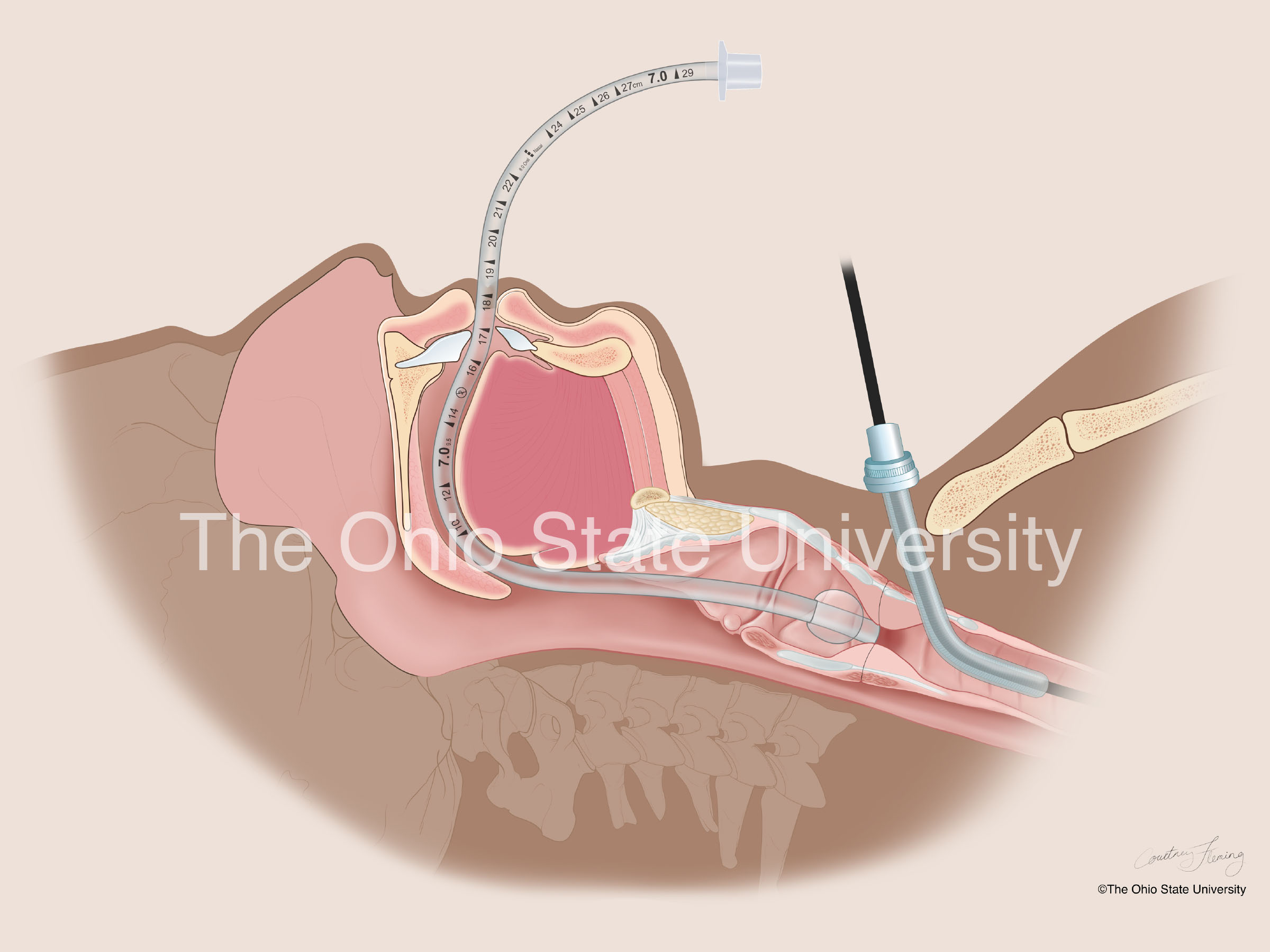 •	Extracorporeal Membrane Oxygenation (ECMO) in patient with stenotic trachea (moderate color)