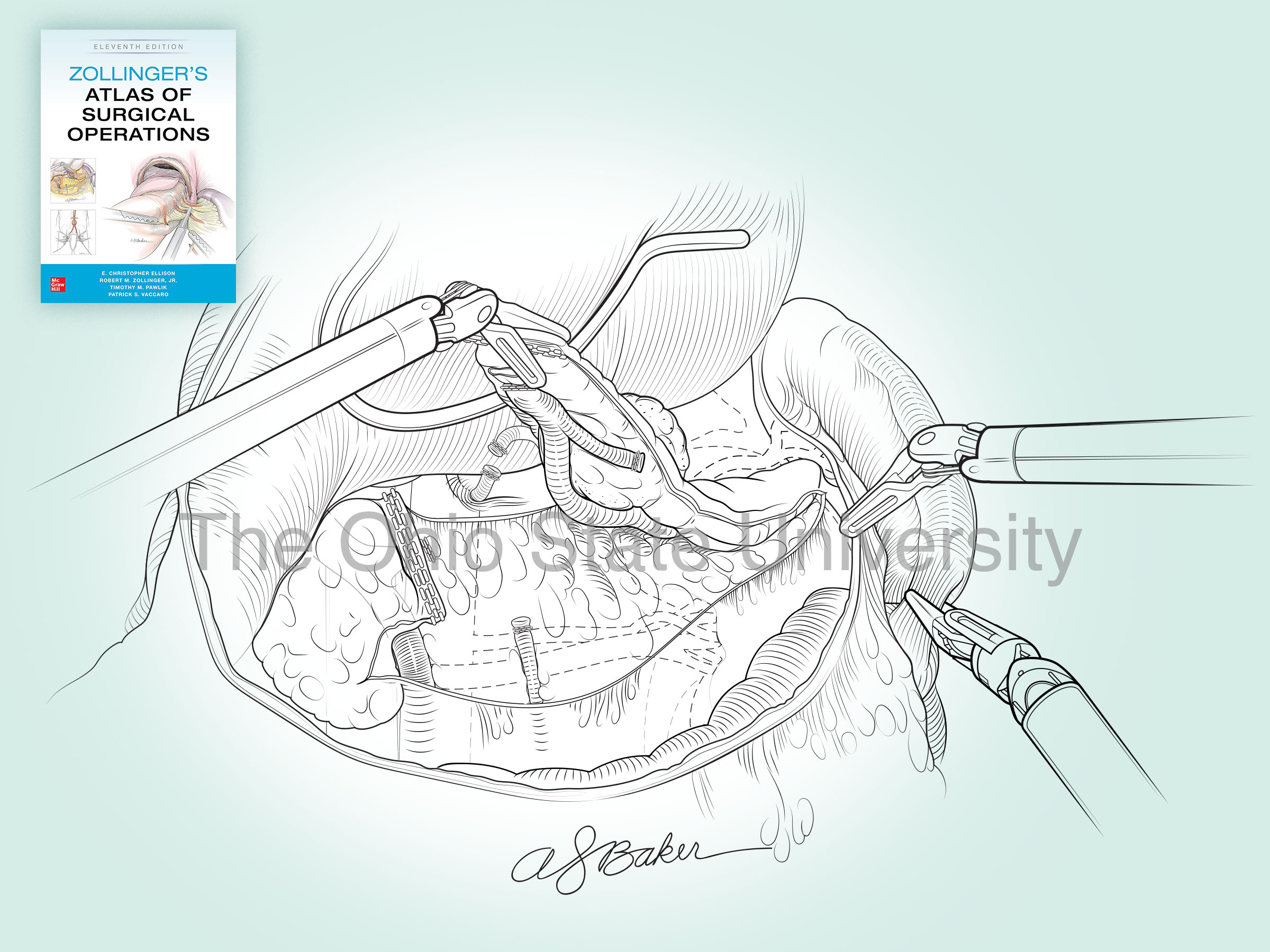 •	Mobilization of spleen during robotic surgical resection of pancreas (complex line)