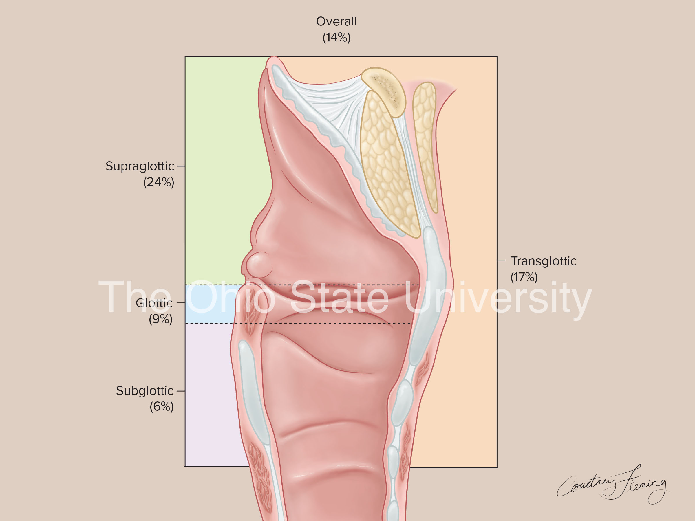 Cross section of larynx showing percentages of lymph cancer in various laryngeal regions (simple color)